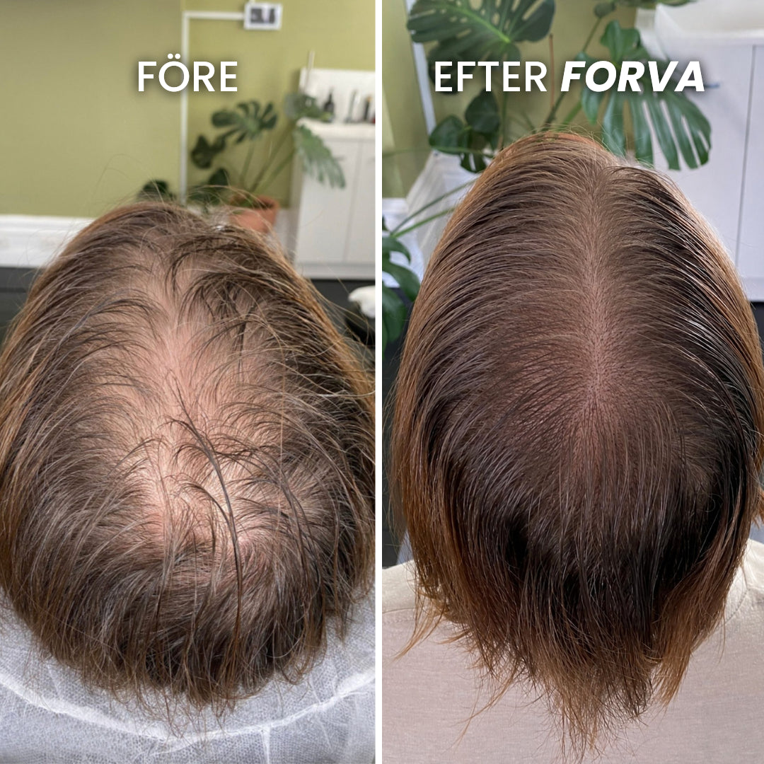 Forva Återväxt-Serum - Kvinnor