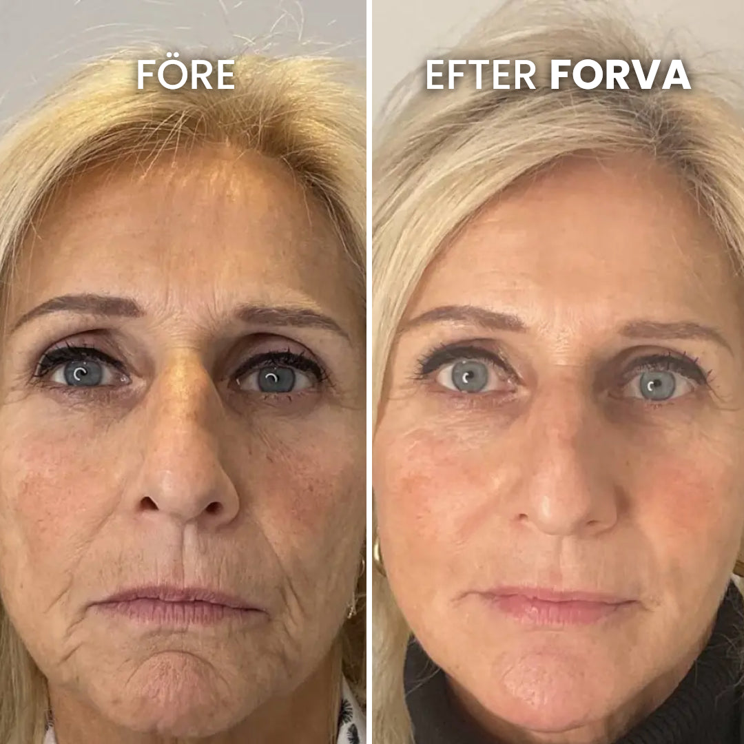 Mikro-Infusion System™